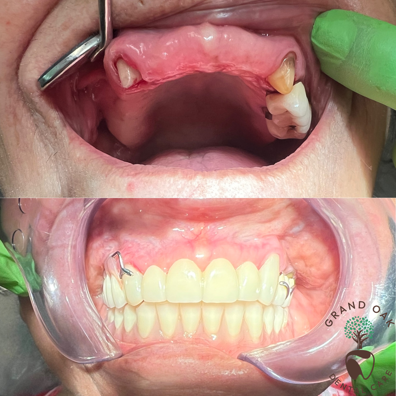 Custom Zirconia Bridge & Partial Denture Combo